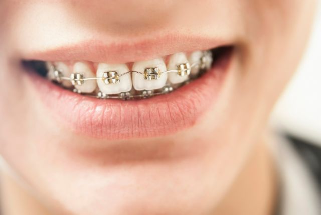 ワイヤー矯正